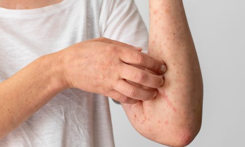 Homeopathy for Skin Allergies