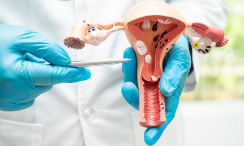 Homoeopathy for Female gynecological disorders