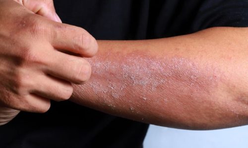 Homoeopathy for Skin Diseases